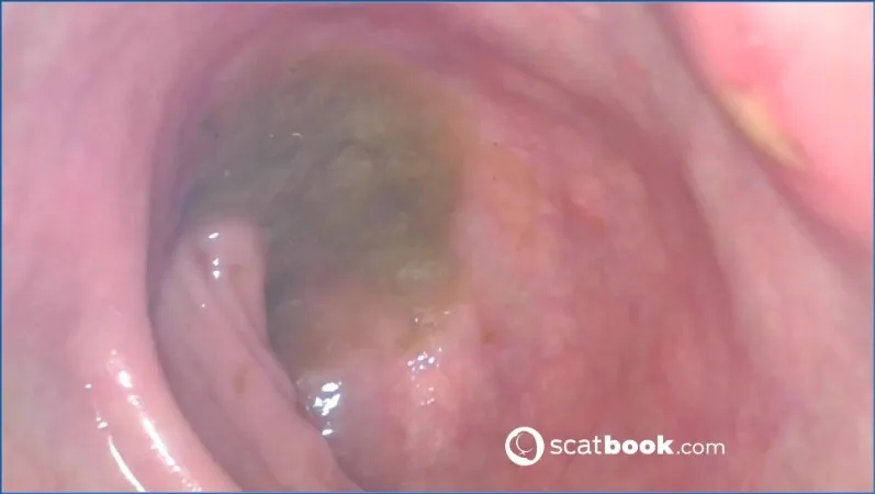 Sweet Tinqerbell pénètre profondément l'endoscope dans son anus - vidéo fétiche